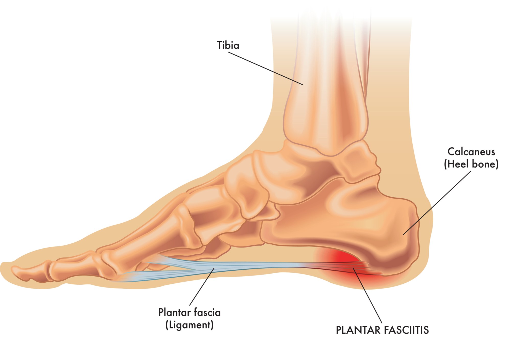 Running with Pain on the Inside of the Ankle — Physiotherapy London Ontario  | Break Free