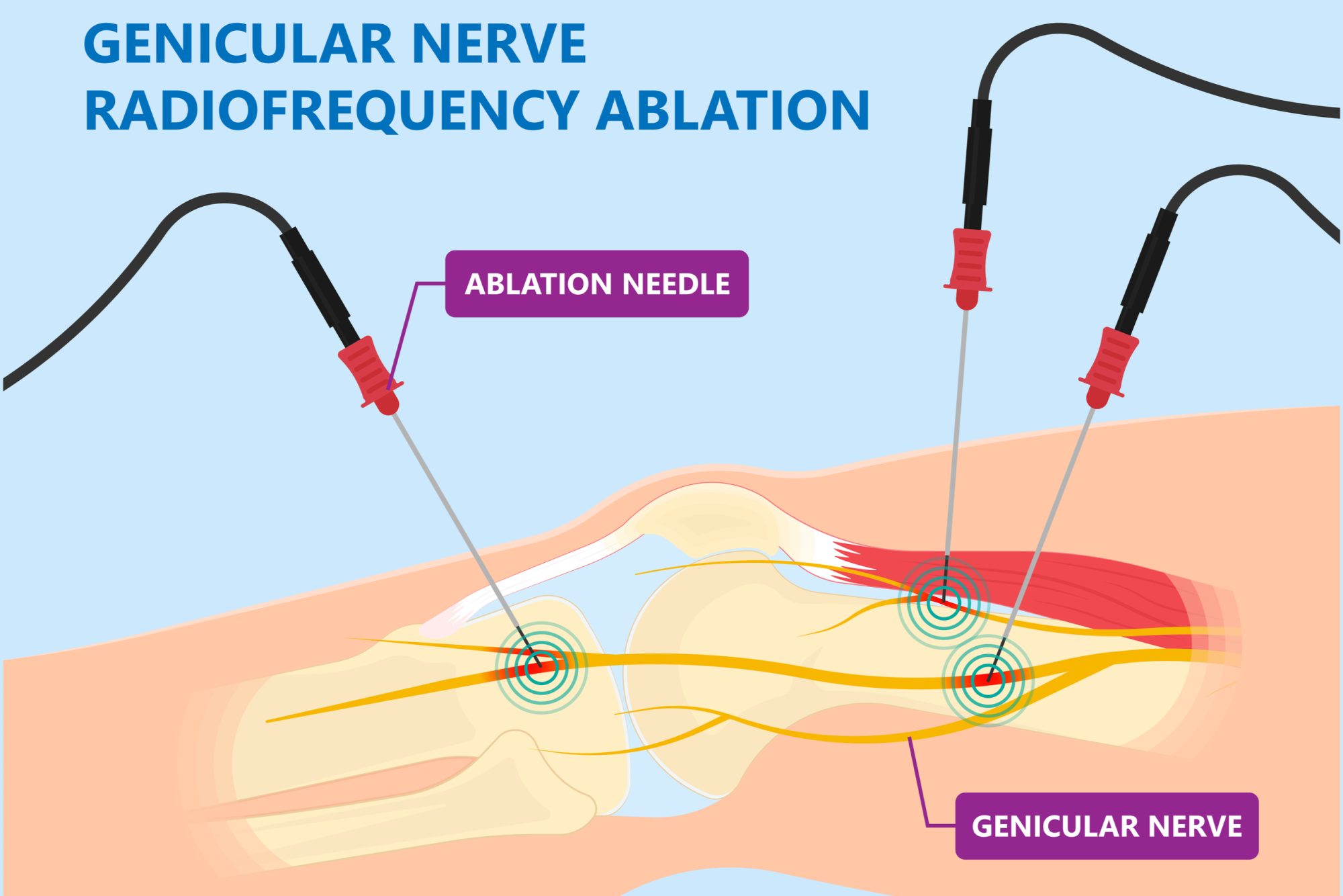 What Is Genicular Knee Block