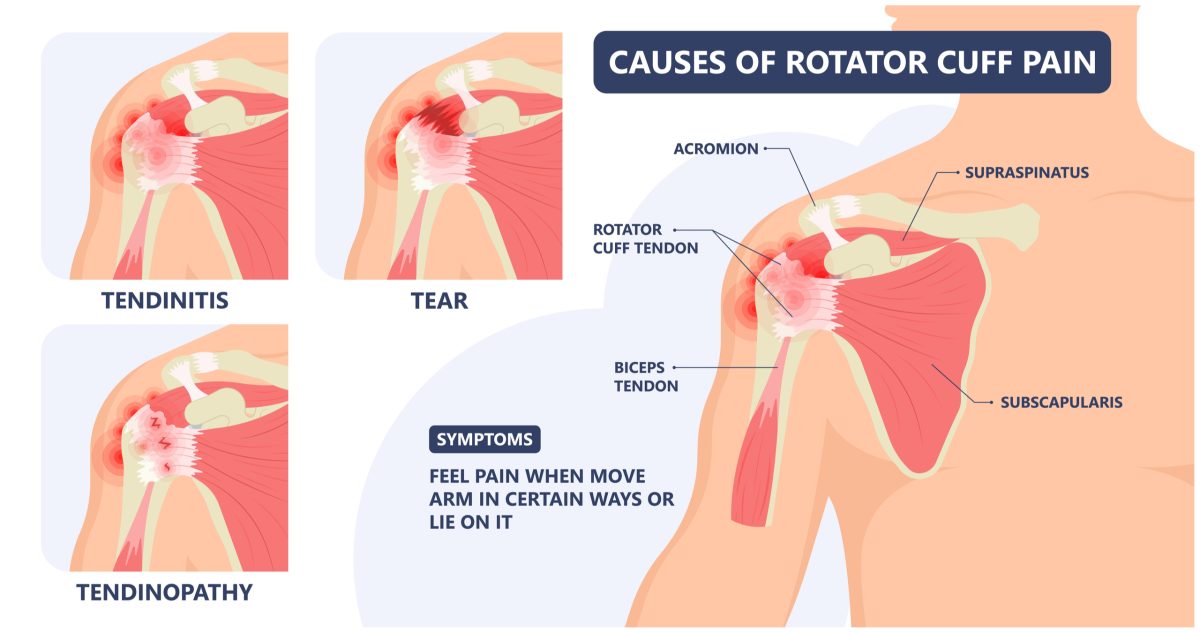 Rotator Cuff Injury & Treatment Options Advanced Surgery Center