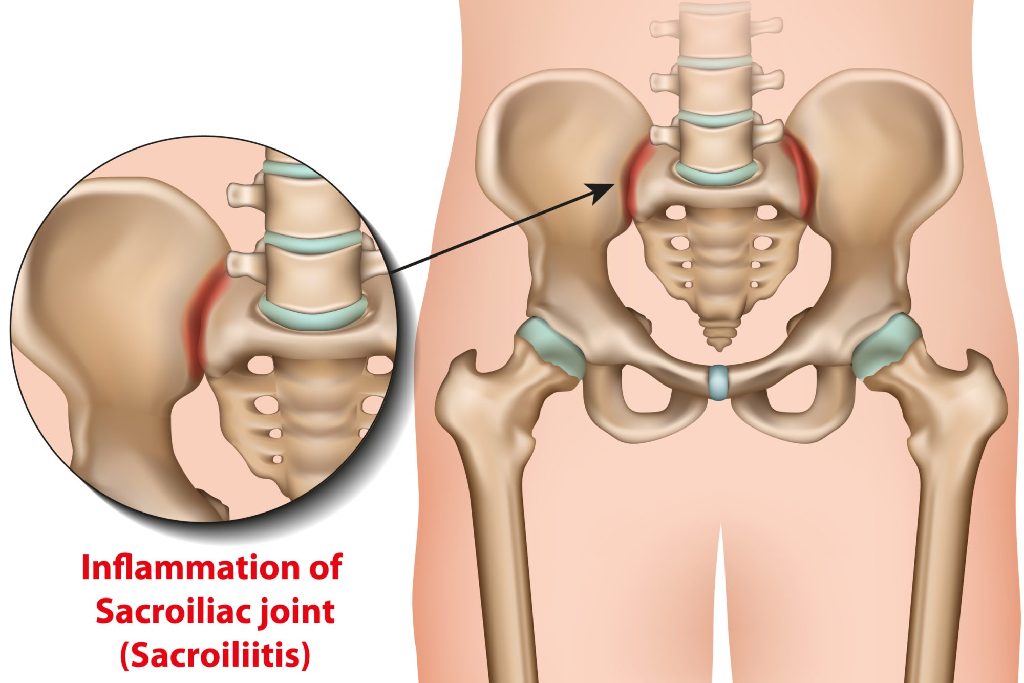 sacroiliac joint inflammation