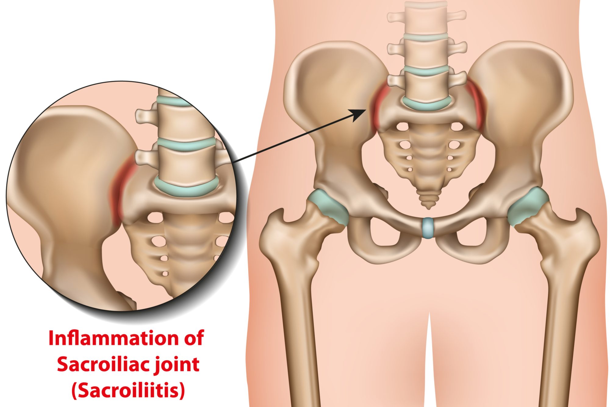 sacroiliac-joint-dysfunction-causes-symptoms-treatment-advanced