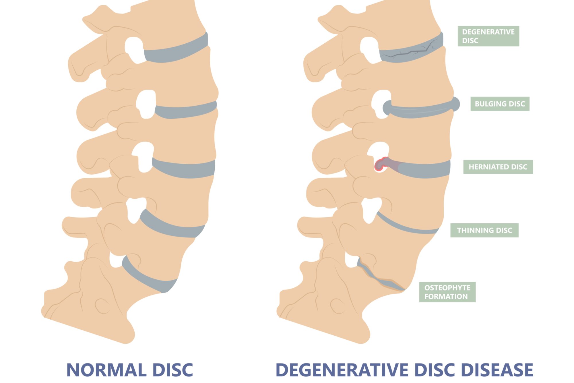 Degenerative Disc Disease Causes Symptoms Treatments Advanced 