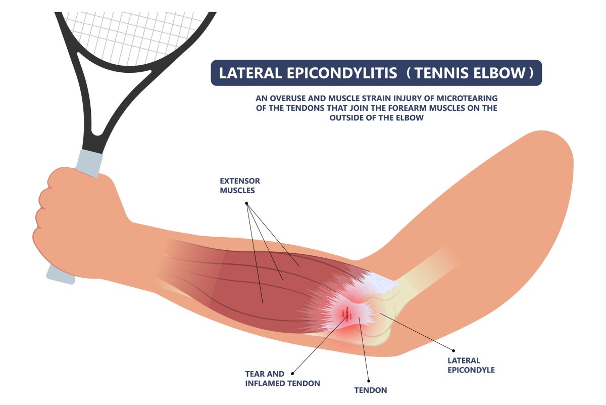 Golfer's Elbow Symptoms, Causes, & Treatments Advanced Surgery Center