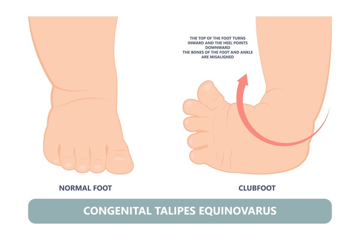 Clubfoot Symptoms, Causes, & Treatments Advanced Surgery Center