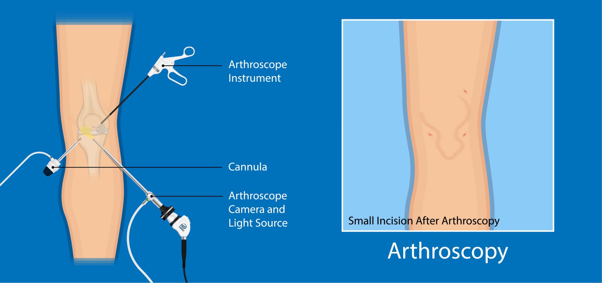 knee-arthroscopy-reasons-procedure-benefits-advanced-surgery-center