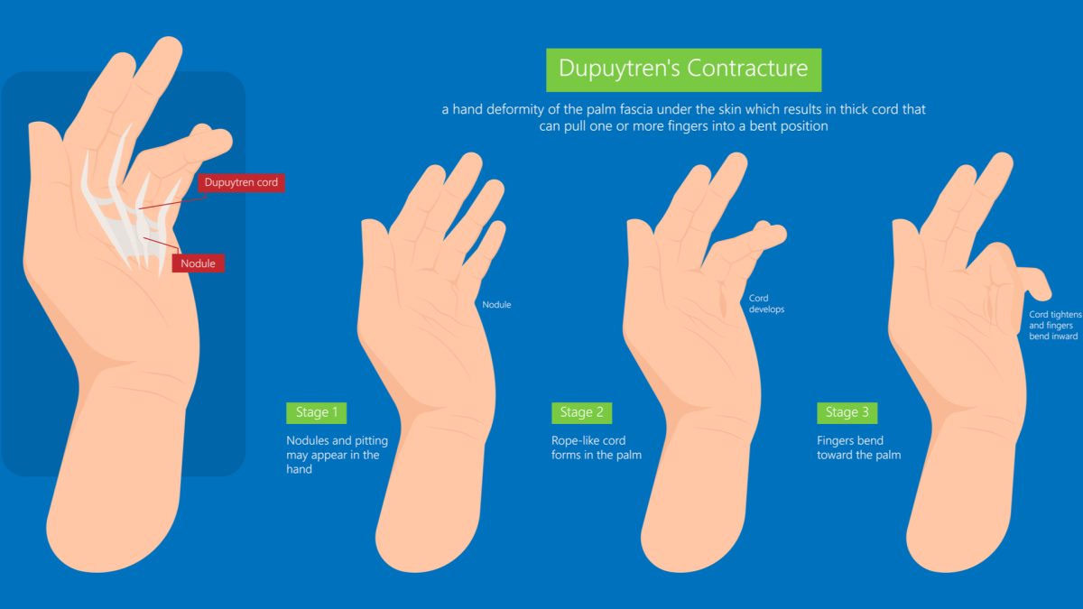Dupuytren's Contracture Symptoms, Causes & Treatments Advanced