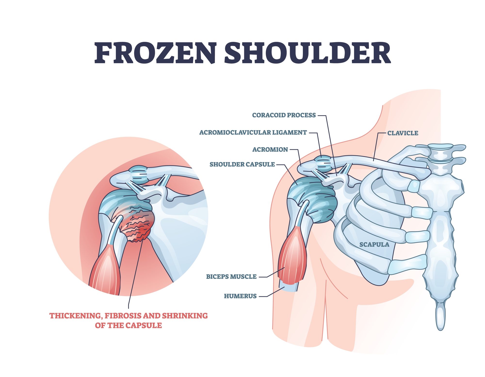 Frozen Shoulder Symptoms Causes Treatments Advanced Surgery Center